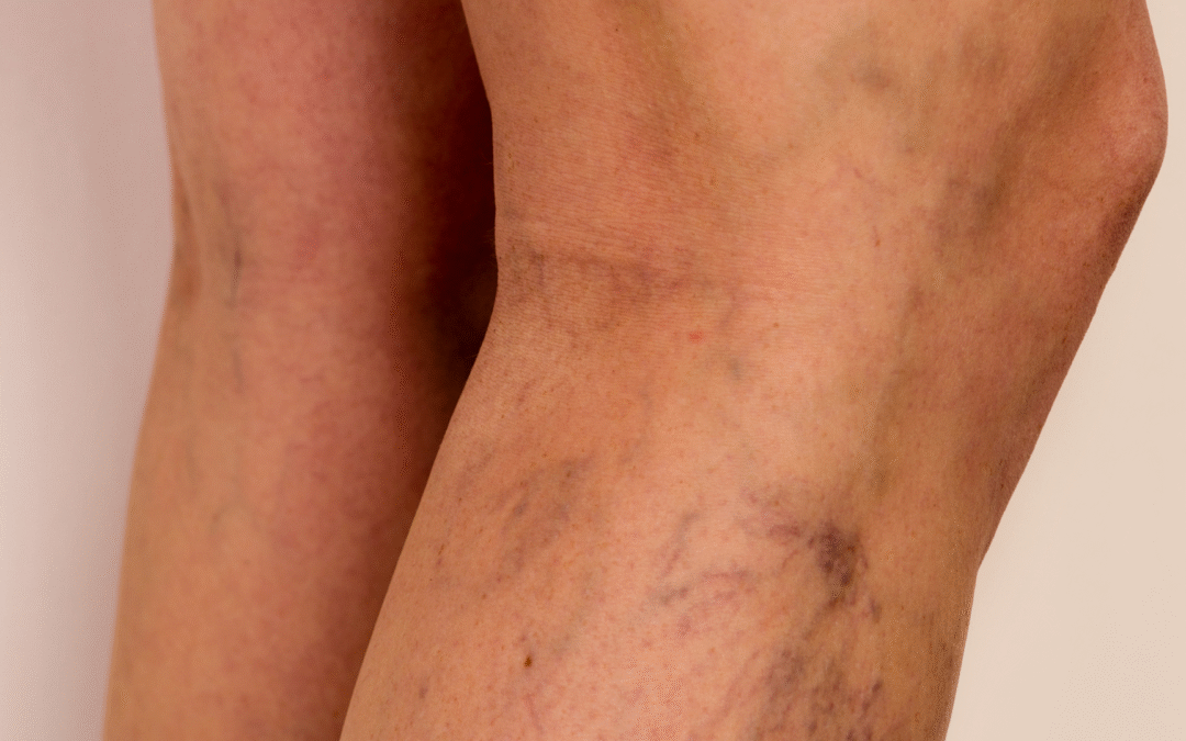 Causas y soluciones naturales para las piernas cansadas